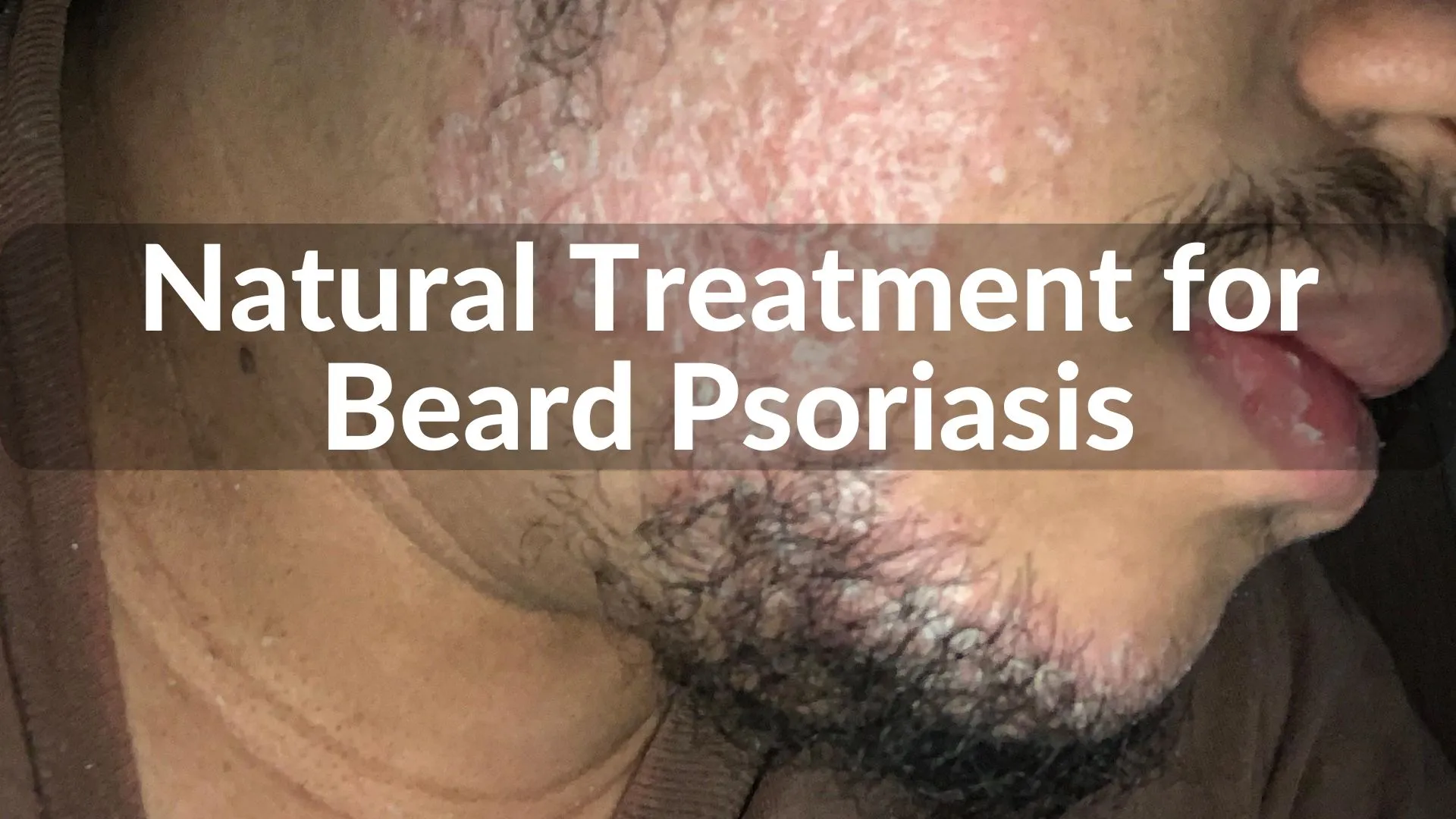 Best Natural Treatments for Beard Psoriasis Healing