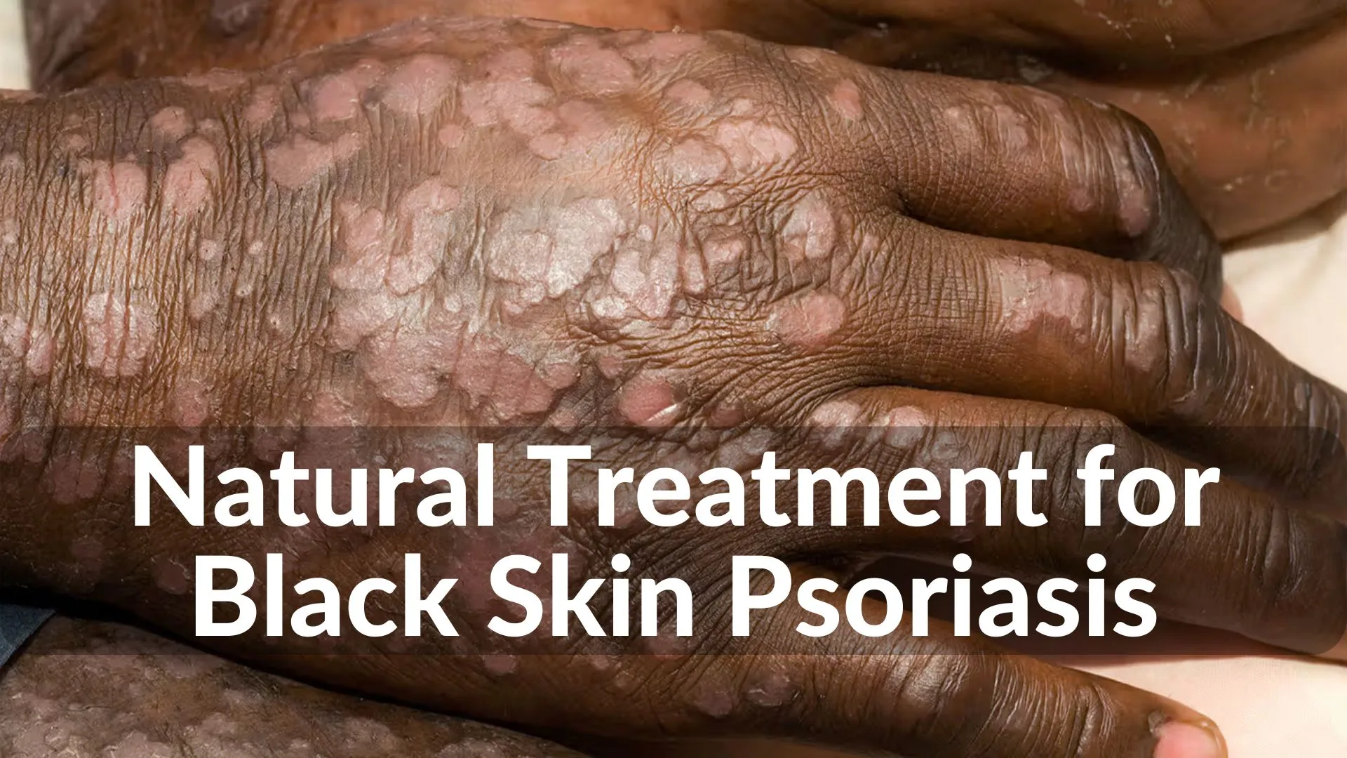 Best Natural Treatments for Black Skin Psoriasis Healing