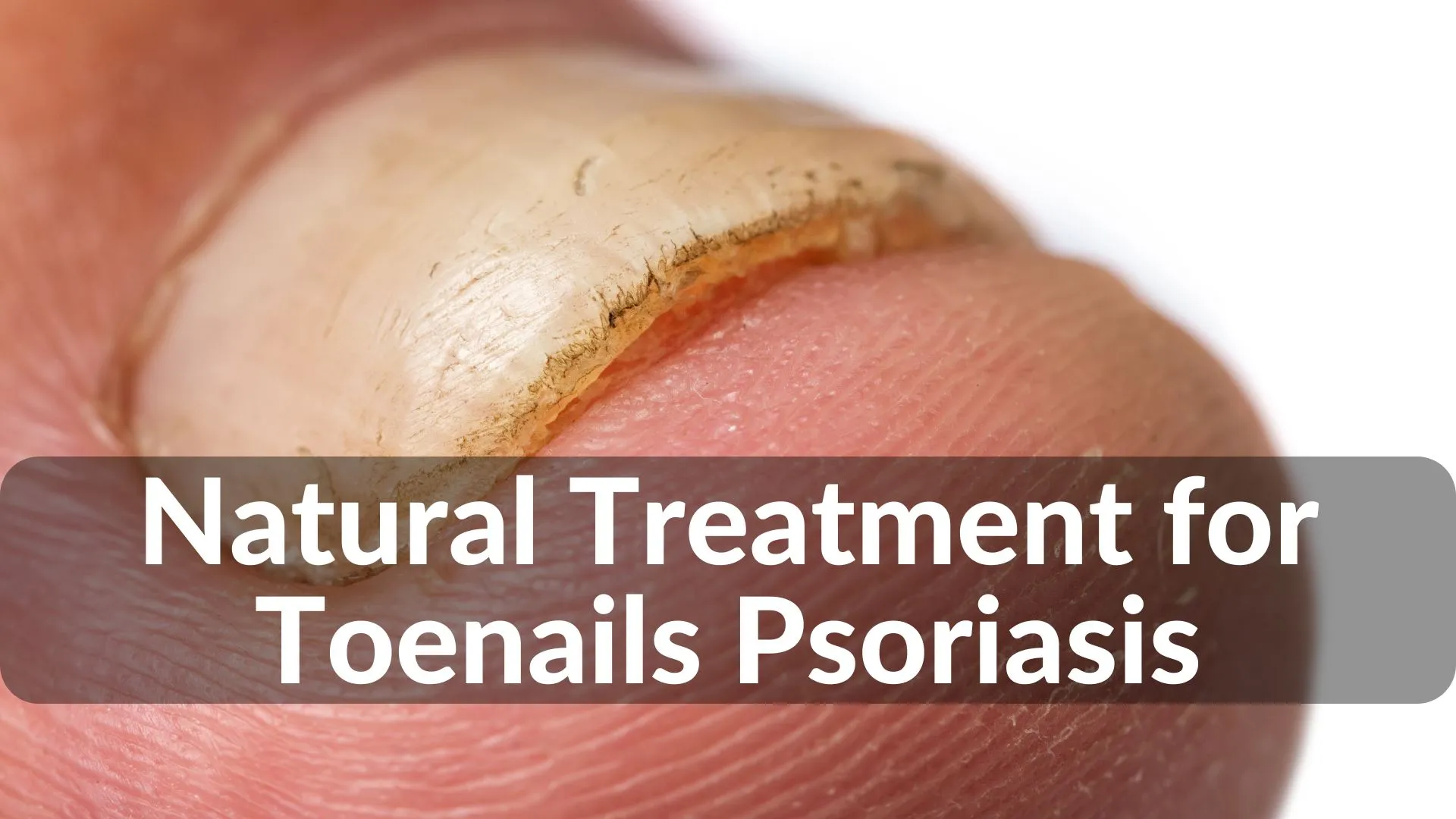 Best Natural Treatments for Toenails Psoriasis Healing