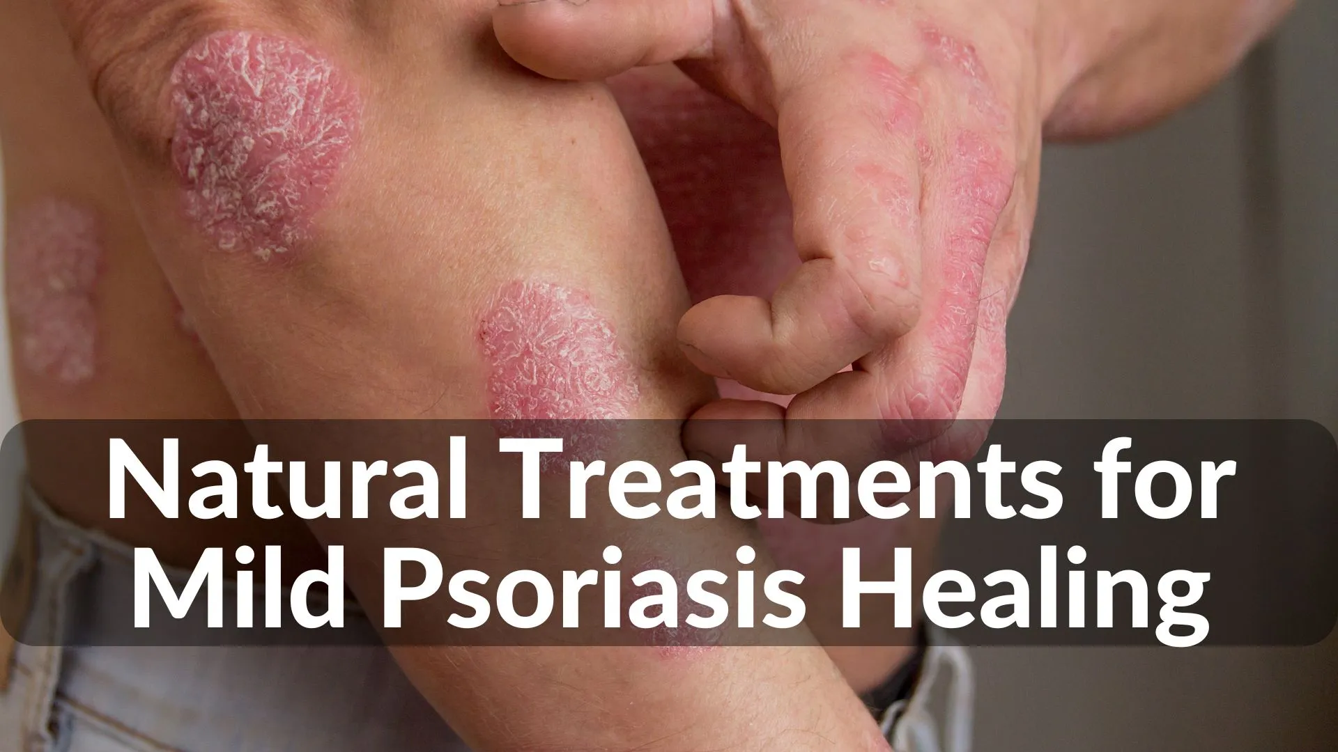 Best Natural Treatments for Mild Psoriasis Healing