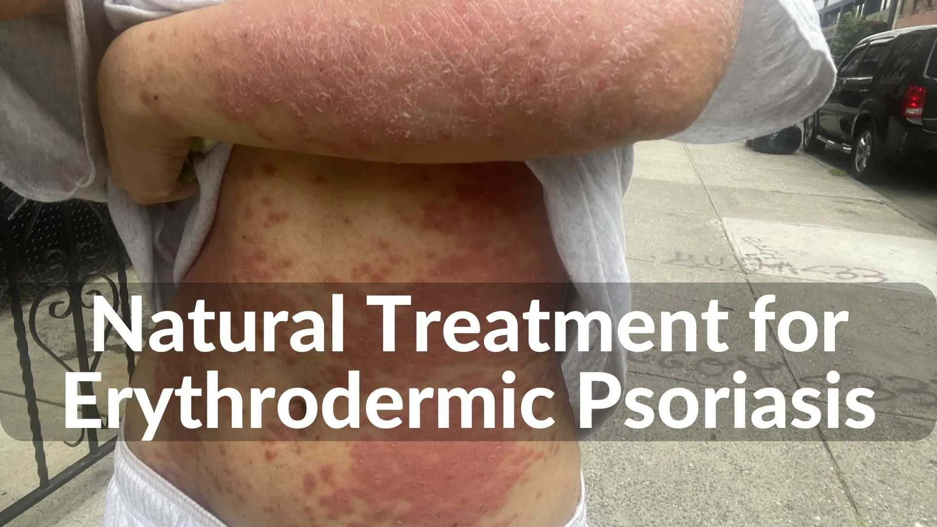 Best Natural and Holistic Treatments for Erythrodermic Psoriasis