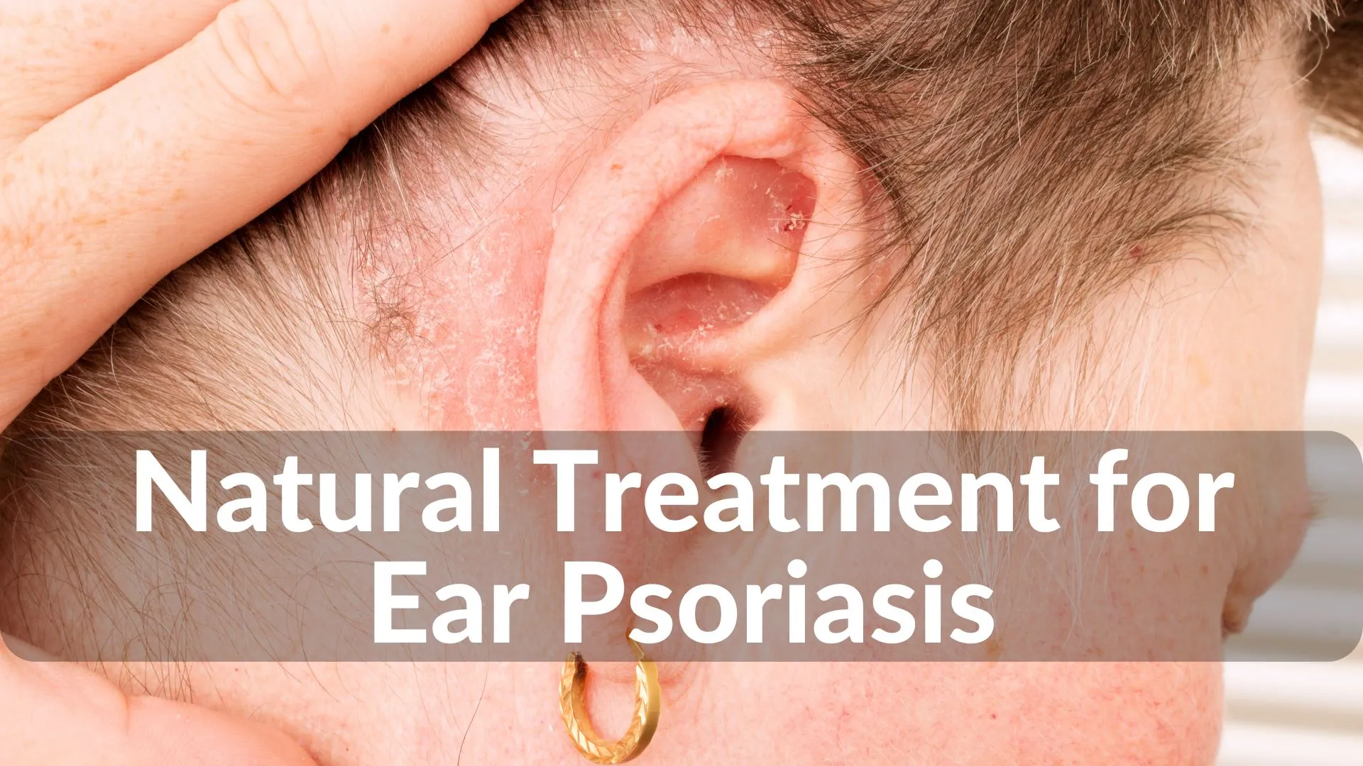 Best Natural Treatments for Ear Psoriasis Healing