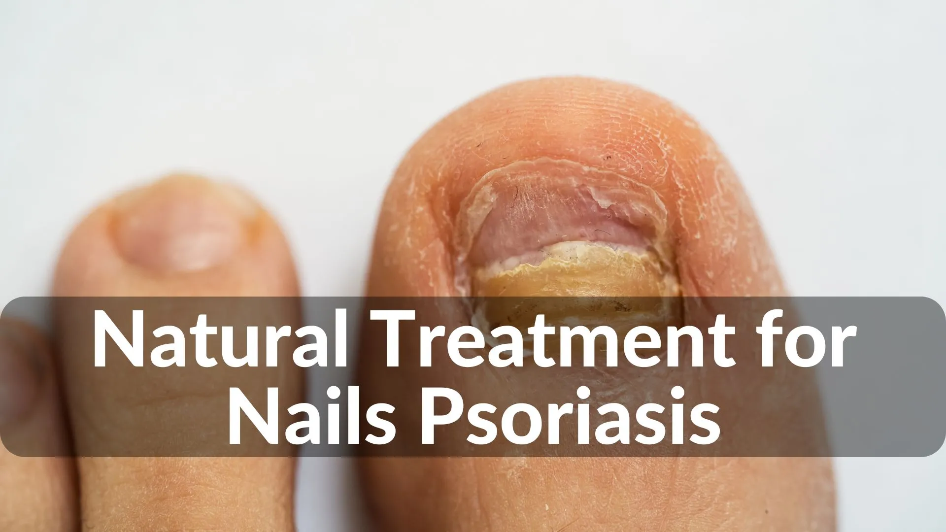 Best Natural Treatments for Nails Psoriasis Healing