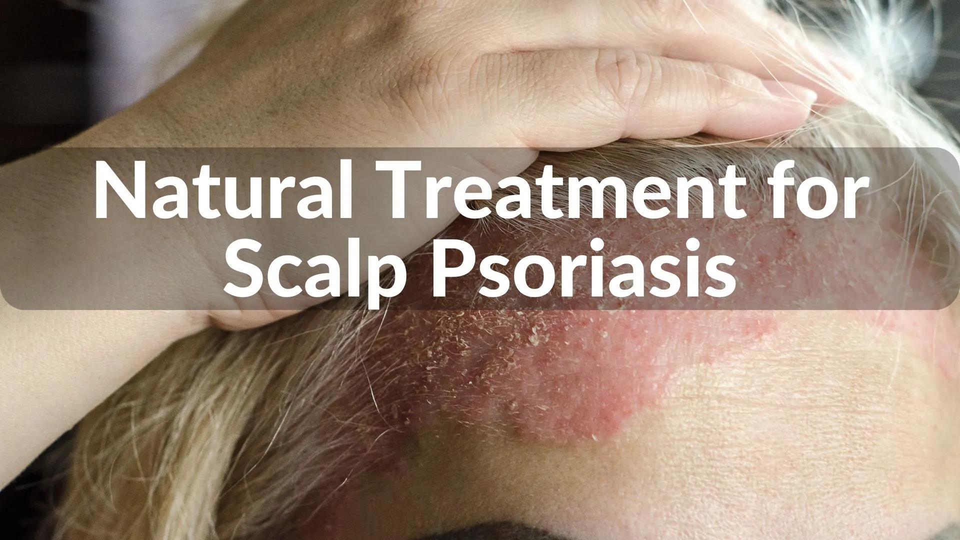 Best Natural Treatments for Scalp Psoriasis Healing