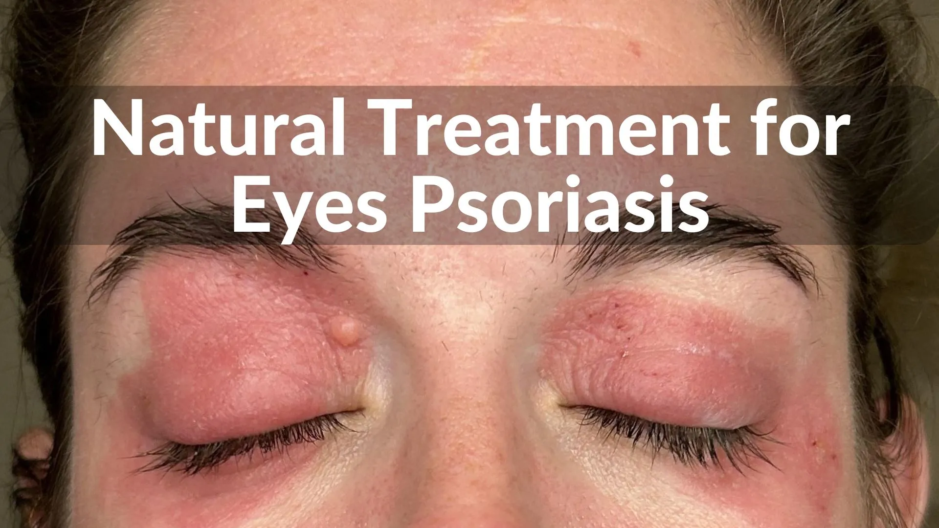 Best Natural Treatments for Eyes Psoriasis Healing