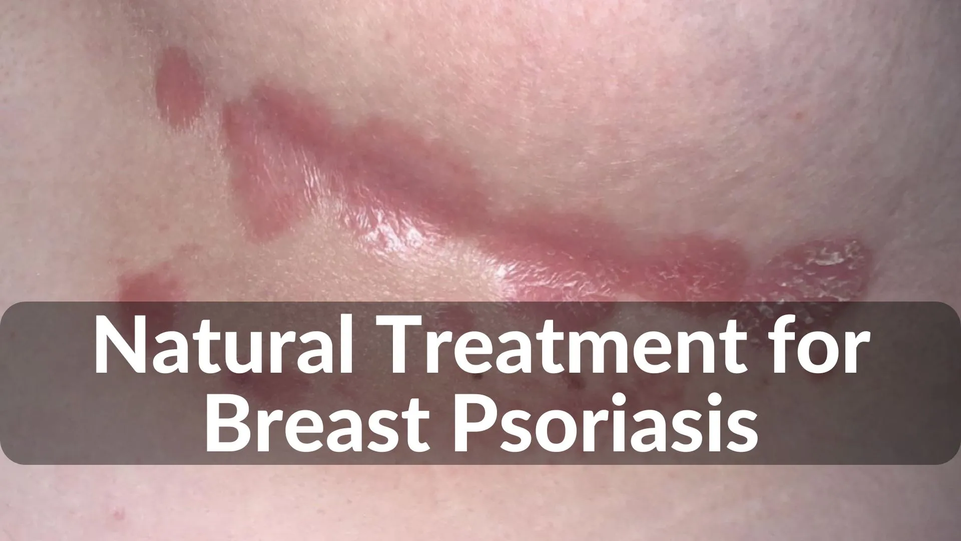 Best Natural Treatments for Breast Psoriasis Healing