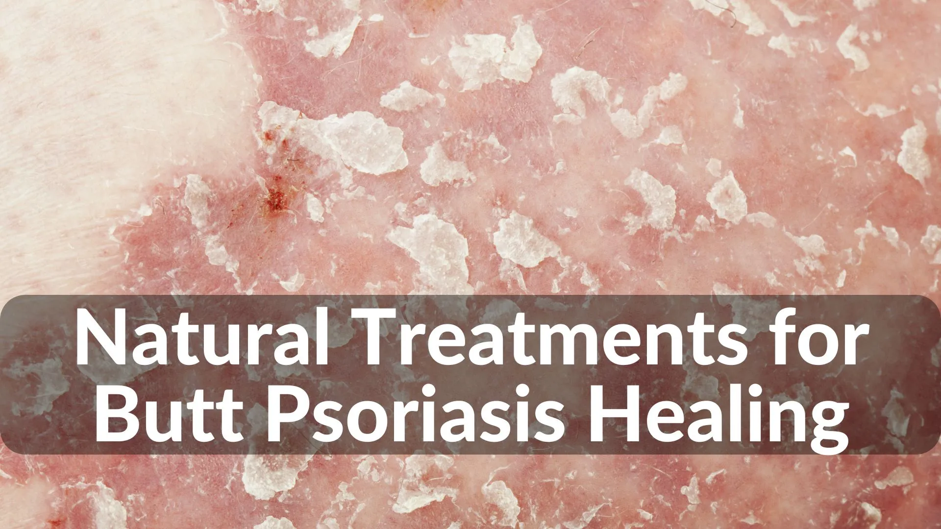 Best Natural Treatments for Butt Psoriasis Healing