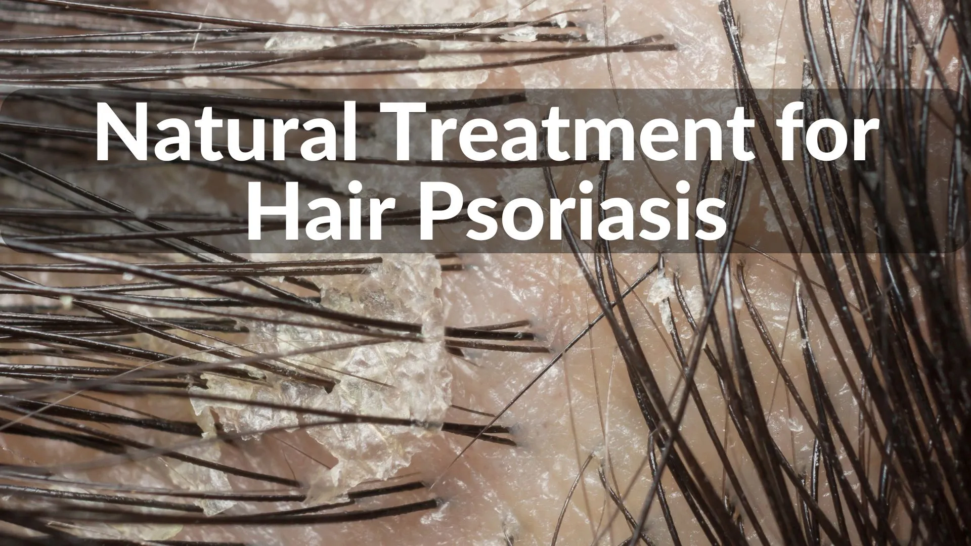 Best Natural Treatments for Hair Psoriasis Healing