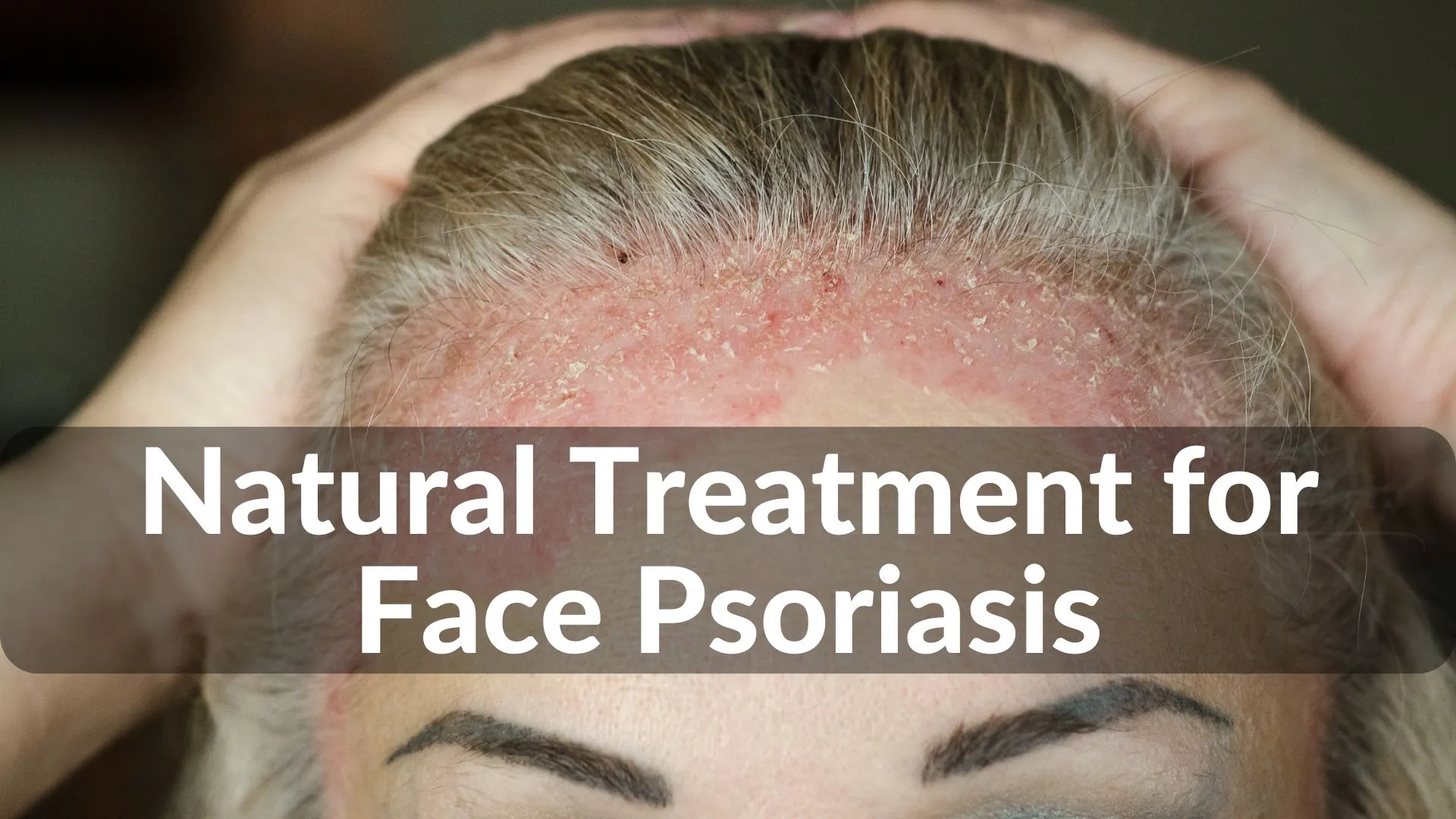 Best Natural Treatments for Face Psoriasis Healing