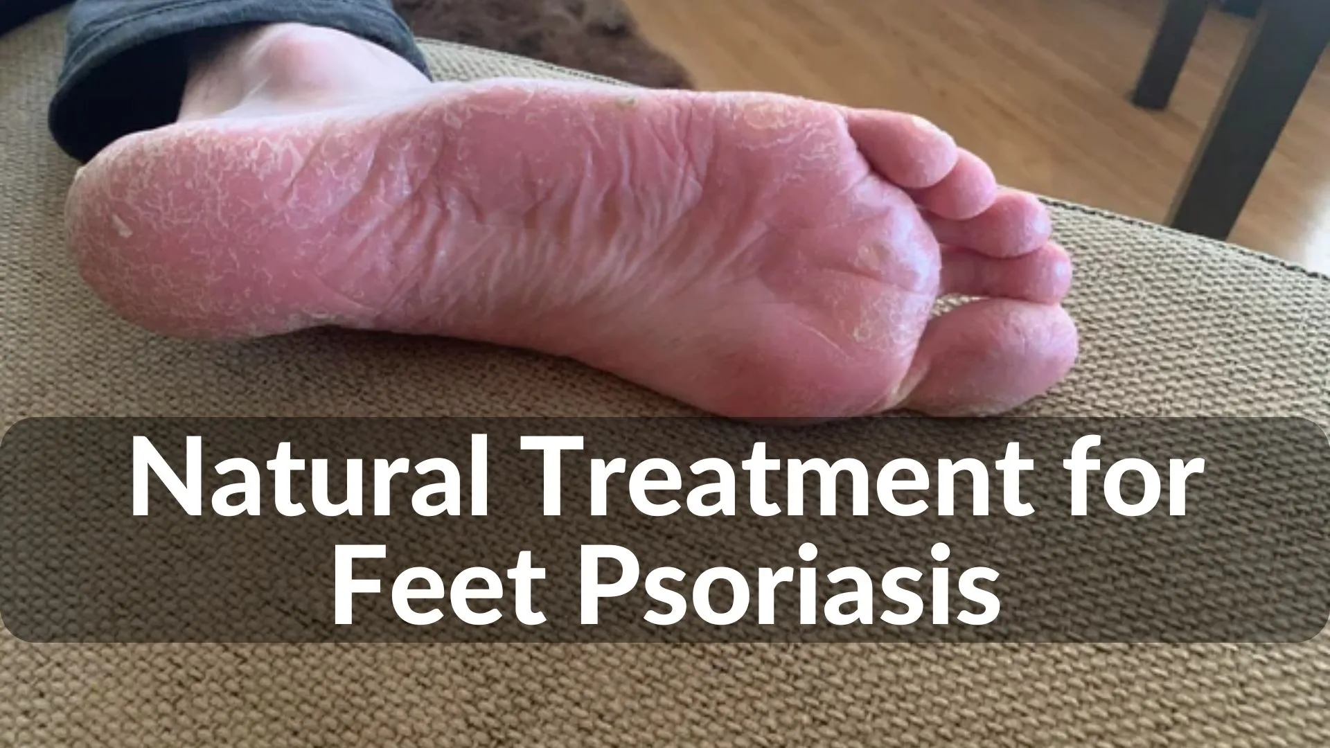 Best Natural Treatments for Feet Psoriasis