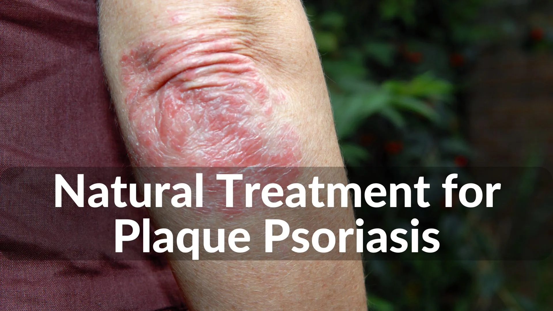 Best Natural Treatments for Plaque Psoriasis: Holistic Healing