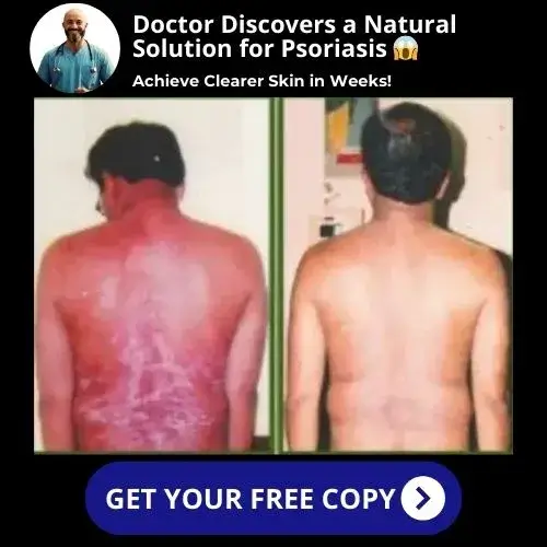 Psodoc Psoriasis Freedom Protocol 2